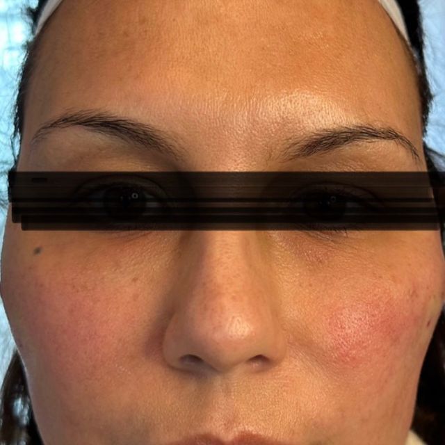 Right side lift picture before the left was done.  What are PDO threads?
Polydioxanone (PDO) threads utilize a biodegradable polyester suture and are best engaged for rejuvenating skin. PDO threads are one of three types of sutures frequently used in thread lift procedures, with the other two made from polylactic acid (PLA) and polycaprolactone (PCA).
This type of thread has been around for the most time out of the three and has been used in surgeries since the 1980s. Made from a colorless polyester, they break down in the body after roughly six months. While present in your skin, PDO threads trigger cells in the body called fibroblasts to produce more collagen, providing the skin its structure and elasticity.#pdothreads #pdothreadlift #facelifting #facelift